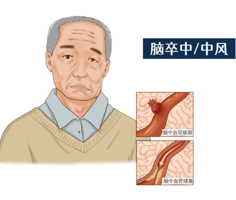 文(wen)獻(xian)解讀(du) | NIR-II熒(ying)光(guang)納(na)米(mi)溫度(du)計(ji)：精(jing)準評估(gu)缺(que)血(xue)性(xing)腦(nao)卒(zu)中的(de)新利器(qi)